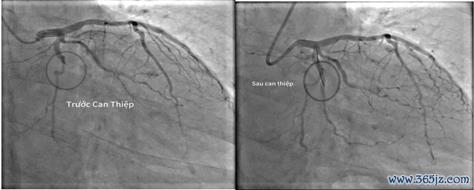 Hình ảnh trước và sau tái thông động mạch. Ảnh: Bệnh viện cung cấp